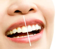 Before and after results of professional teeth whitening in Billings MT at Big Sky Family Dental
