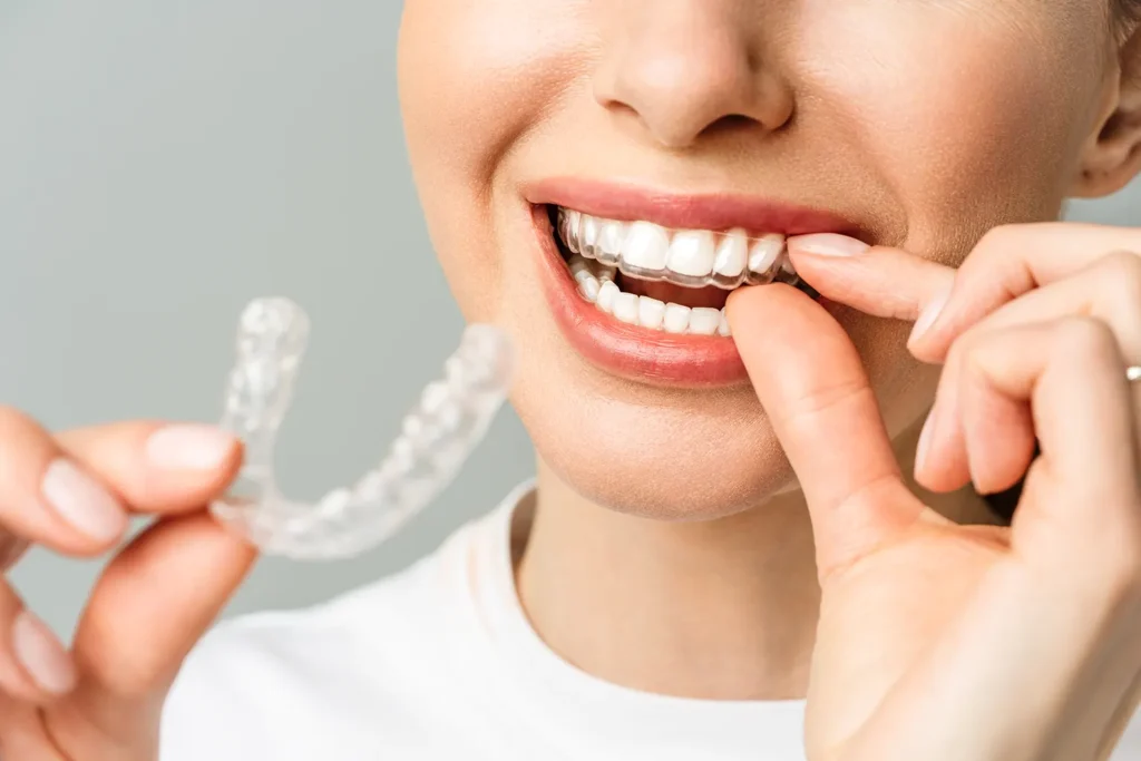 ClearCorrect aligners in Billings MT shown as a clear aligner tray being placed on teeth at Big Sky Family Dental